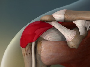 bursitisshoulder_300