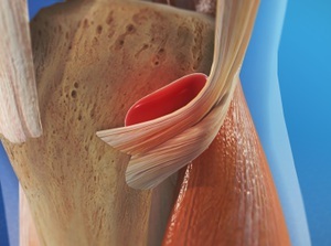 goosefootbursitis_300