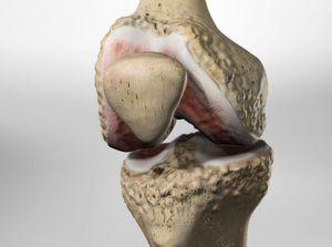 kneearthritis_300