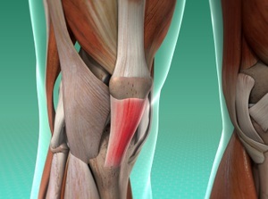 patellartendonitis_300