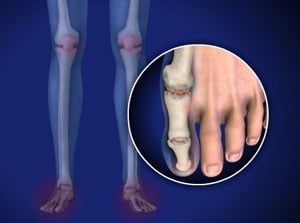 rheumatoidfootankleaf_300